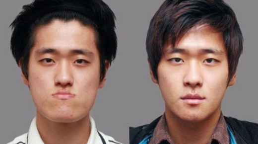 Korean Plastic Surgery – Before and After