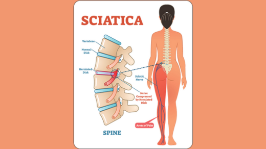 What is Sciatica? Symptoms | Causes | Treatment option