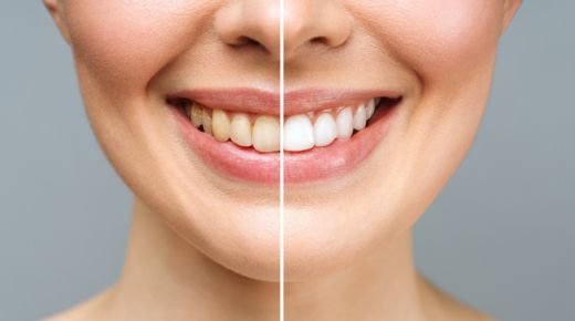 The Challenge of Discolored Dental Crowns – Can They Be Whitened?