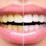 Professional Teeth Whitening or Take-Home Whitening Teeth: Which Procedure is Right for You in Weston, MA?