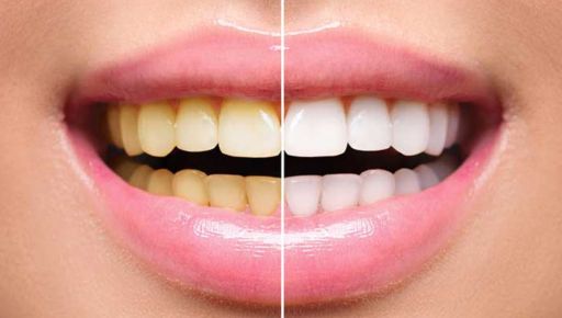 Professional Teeth Whitening or Take-Home Whitening Teeth: Which Procedure is Right for You in Weston, MA?