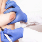 A Comprehensive Guide to Gynaecomastia and Surgery Options in Bangalore