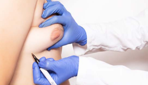 A Comprehensive Guide to Gynaecomastia and Surgery Options in Bangalore